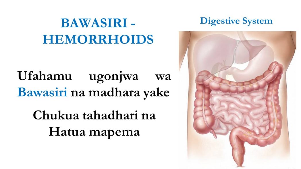 Hadithi 8 za uongo kuhusu bawasiri